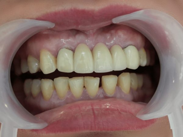 Bọc răng sứ bị hư răng thật khi mão sứ không khít sát gây sâu răng